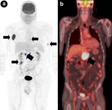 Metastatic Melanoma Survival Rate