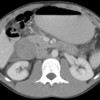 CT scan of the abdomen showing a rounded heterogeneous mass compressing the second part of duodenum