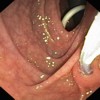 Endoscopic image from second part of the duodenum showing grooving and nodularity in the duodenum