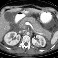 CT image showing a diffusely enhancing and enlarged pancreas with hypodense foci in the pancreatic head