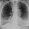 Chest X-ray showing mediastinal mass