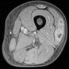 MRI (T1) axial section of thigh with gadolinium injection