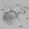 Transarterial selective angiography of the celiac axis, showing a hypervascular lesion of the head of the pancreas