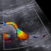 Doppler ultrasonography showing no apparent tumoral vascularization