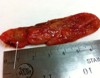 Gallbladder specimen with heterotopic pancreas