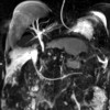 MRI abdomen showing pancreatic necrosis compressing on the common bile duct