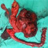 Macroscopic appearance of resected specimens showing tumor attached mainly along the pancreatic head