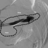 Splenic vein venography