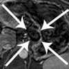 T1 post-contrast subtraction imaging shows the mass having a black non-enhancing center, with a thin rim of peripheral enhancement