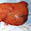 Accessory spleen in the tail of pancreas