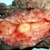 Nodular mass in the common bile duct lumen