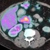 PET CT image shows diffuse uptake of contrast in the head of the pancreas