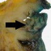 Axial slice of the head of the pancreas