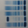 A sharp M band in the gamma-globulin region detected on serum protein electrophoresis
