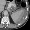 CT scan showing a large pseudocyst and subcapsular splenic haemorrhage