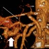 3D paracoronal MIP arterial phase reconstruction