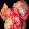 Gross specimen showing a large lobulated tumor in relation to the body and tail of the pancreas