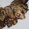 Solid and cystic areas in a tumor localized in the head of the pancreas