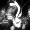 MRCP showing cystic dilation of terminal part of main pancreatic duct