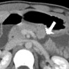 CT scan of the abdomen demonstrating complete transection of the pancreas