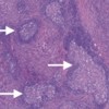 Several hyperplastic lymphoid follicles