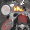 Space-occupying lesion with cellular proliferation