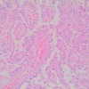Microscopic findings of solid-pseudopapillary neoplasm