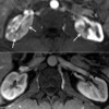 Axial post contrast T1WI through the level of the kidneys