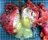 Gross pancreaticoduodenectomy specimen