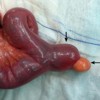 Mass arising from the distal end of the diverticulum