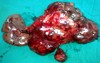 Pancreatic tumor with spleen