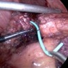 Pancreatic ductotomy with exposure of the impacted 5 Fr pigtail pancreatic duct stent