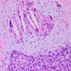 Foreign body giant cells