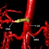 3D reconstruction with the stump of the celiac axis