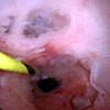 Peroral pancreatoscopy reveals a fish egg-like appearance