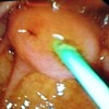Papilla with separate bile duct and pancreatic duct orifice
