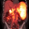 PET/CT scan showing extensive FDG-avid tumor featuring