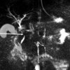 MRI showing portal cavernoma