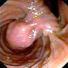 Proximal view of gangliocytic paraganglioma