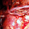 Post pancreaticoduodenectomy-preserved hepatomesenteric trunk