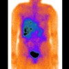 Nuclear octreotide scintigraphy