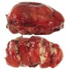 Cysts enveloped by a fibrotic capsule