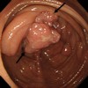 Gastric tumor in the middle part of the stomach