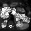 Lobulated fluid cysts with a “bunch of grapes” pattern