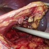 Laparoscopic view of the mobilization of the spleen and pancreatic tail