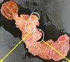 Location of a pancreatic somatostatinoma and lymph node metastases