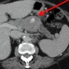 Large mid-pancreatic body mass