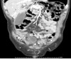 A low-attenuation mass in the head of the pancreas and uncinate process