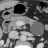 CT scan showing a 4 cm cystic fluid mass arising from the tail of the pancreas