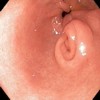 Subepithelial lesion in the gastric antrum